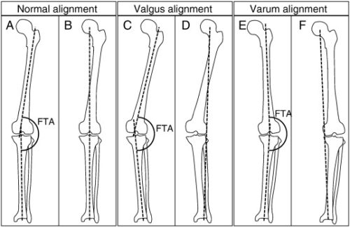 Lower Limb Alignment Riding COSM | High Tibial Osteotomy (with or without ACL Reconstruction)